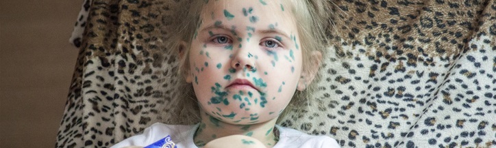Portrait of cute little girl 3-4-5 years old with sad eyes, with chickenpox, pimples anointed with green medicinal preparations, colored spots on the body.